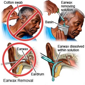 Earwax Removal