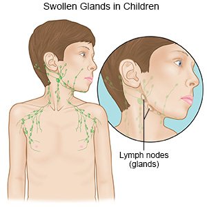 Swollen Glands in Children