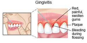 Gingivitis