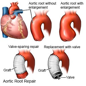 Aortic Root Repair