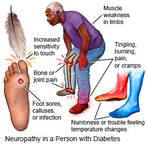 Neuropathy in Diabetes