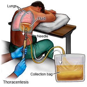 Thoracentesis