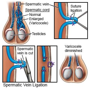 Spermatic Vein Ligation