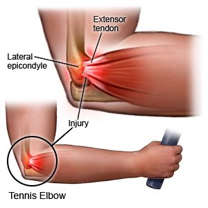 Tennis Elbow