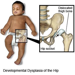 Developmental Dysplasia of the Hip