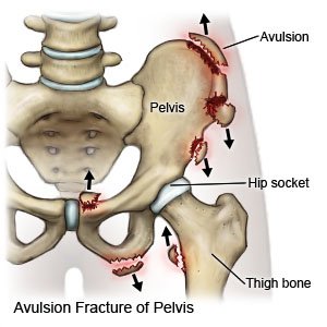 Avulsion Fracture of Pelvis