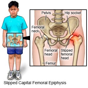 Slipped Capital Femoral Epiphysis