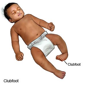 Clubfoot
