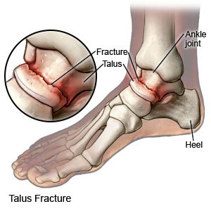 Talus Fracture