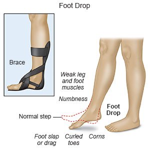 Foot Drop