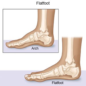 Flatfoot