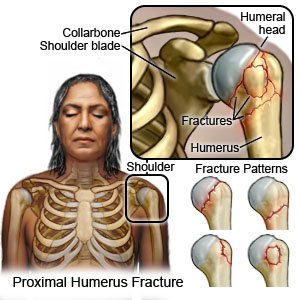 Proximal Humerus Fracture