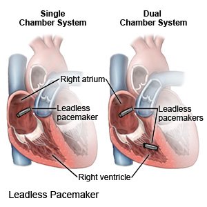 Leadless Pacemaker