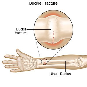 Buckle Fracture