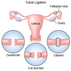 Tubal Ligation