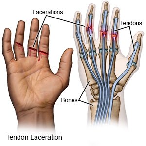 Tendon Laceration