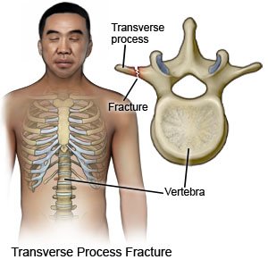 Transverse Process Fracture