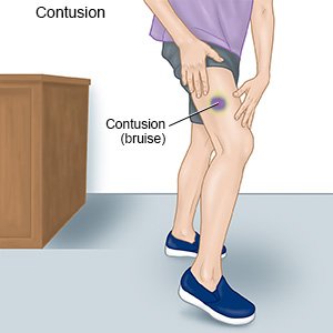 Contusion