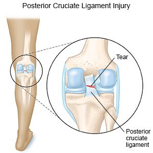 Posterior Cruciate Ligament Injury