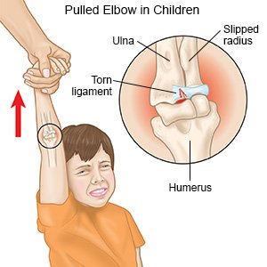 Pulled Elbow in Children