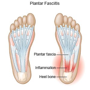 Plantar Fasciitis