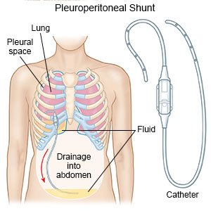 Pleuroperitoneal Shunt