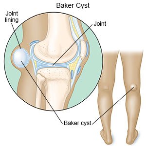 Baker Cyst