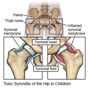 Toxic Synovitis of the Hip in Children