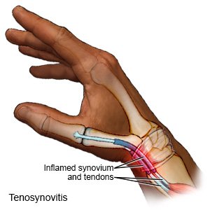 Tenosynovitis