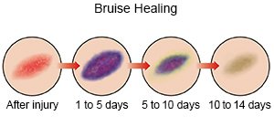 Bruise Healing