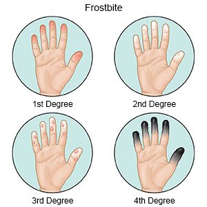 Frostbite