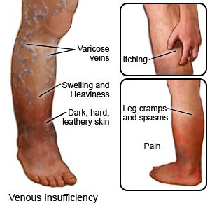 Venous Insufficiency