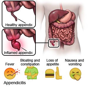 Appendicitis
