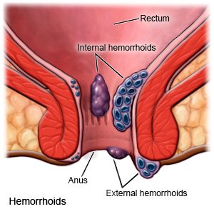 Hemorrhoids