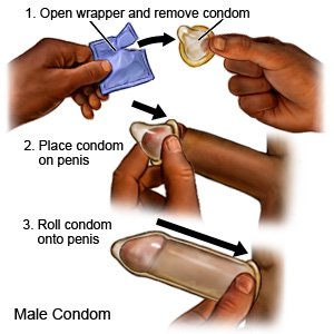 Male Condom