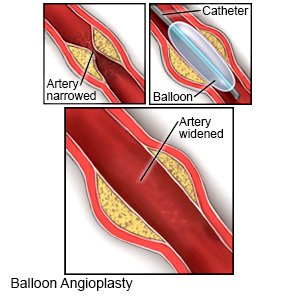 Balloon Angioplasty