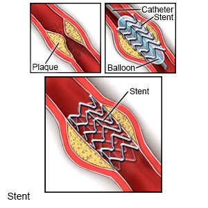 Stent