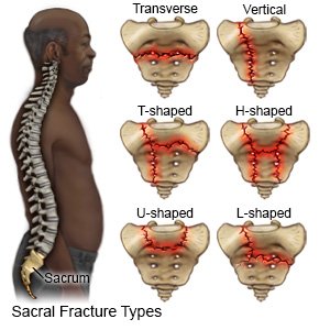 Sacral Fracture
