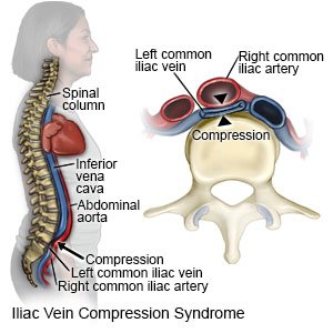 Iliac Vein Compression Syndrome