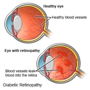 Diabetic Retinopathy