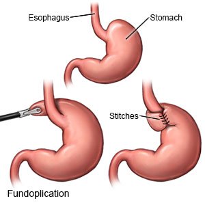 Fundoplication