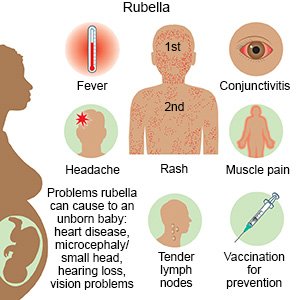 Rubella