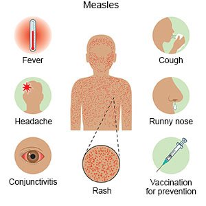 Measles