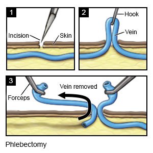 Phlebectomy
