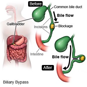 Biliary Bypass