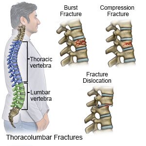 Thoracolumbar Fracture