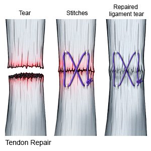 Tendon Repair