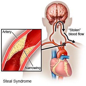 Steal Syndrome