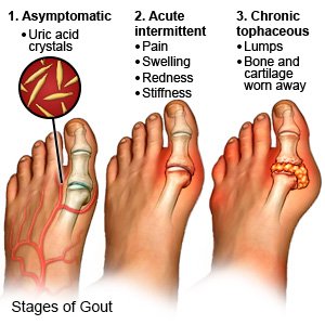 Gout
