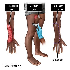 Skin Grafting